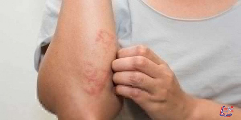 علاج حكة الجسم بالعلاجات الطبية والطبيعية وأسبابها