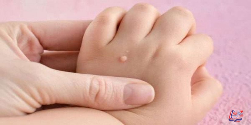 طرق علاج الثالول