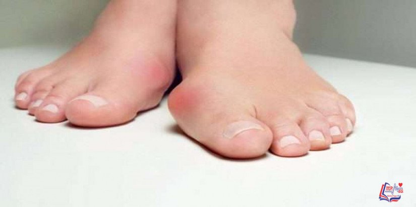 إبهام القدم الأروح Bunions
